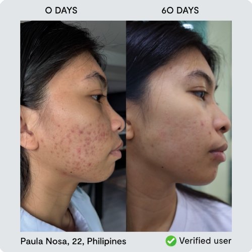 nor sken transformation paula nosa - Tim